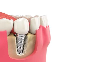 Soluciones para la colocación de implantes dentales en casos de pérdida de hueso dental