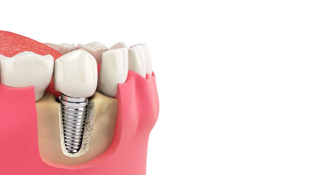 Soluciones para la colocación de implantes dentales en casos de pérdida de hueso dental