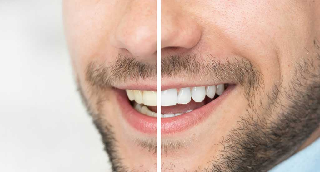 Todas las Claves sobre el Blanqueamiento Dental