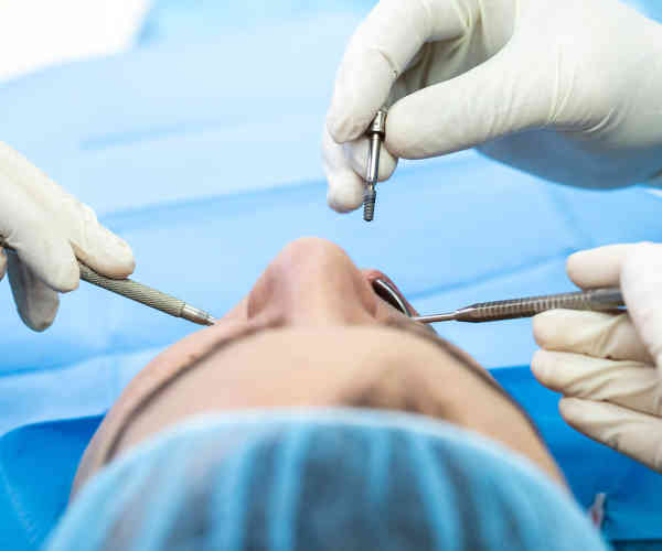 Beneficios de los implantes dentales - implantología dental en Albacete