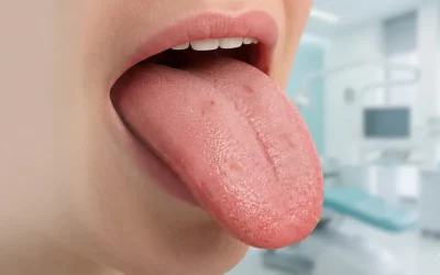 Puntos rojos en la lengua y VPH: Causas, síntomas y cuándo acudir a tu dentista en Albacete