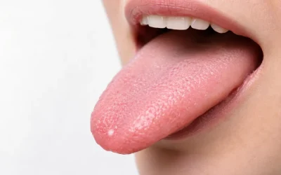 Grano blanco en la lengua: causas, remedios y tratamiento